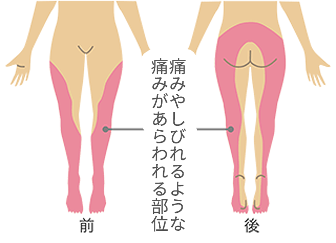 坐骨神経痛とは?